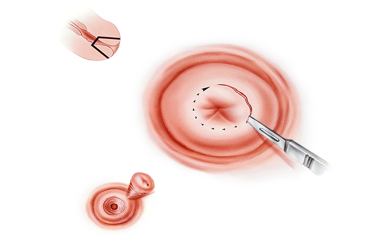 Konizasyon Ameliyatı Nedir? Nelere Dikkat Etmeliyim?