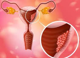 Rahim Ağzı Kanseri ve Belirtileri