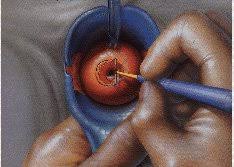 LEEP Ameliyatı Sonrası İyileşme