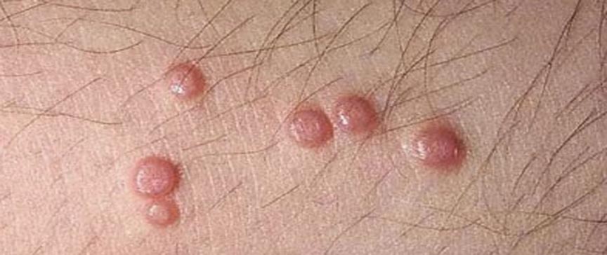 Genital Siğil Nasıl Bulaşır? Korunma Yolları