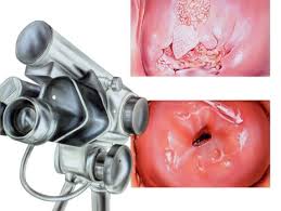 Kolposkopi Nedir? Ne Zaman Rahim Ağzı Biyopsisi Yapılır? Birol Vural anlatıyor