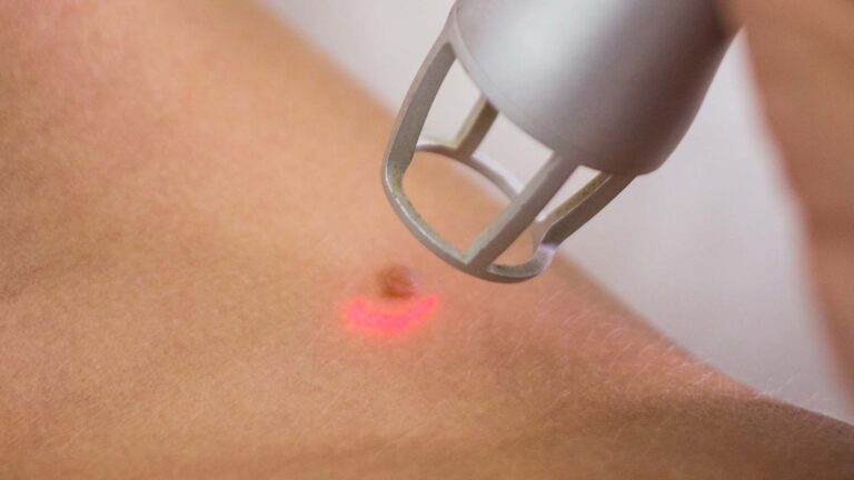 Genital Siğil Tedavisinde Lazer ve Kriyoterapi Karşılaştırması