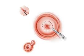 Konizasyon Kanser Demek mi