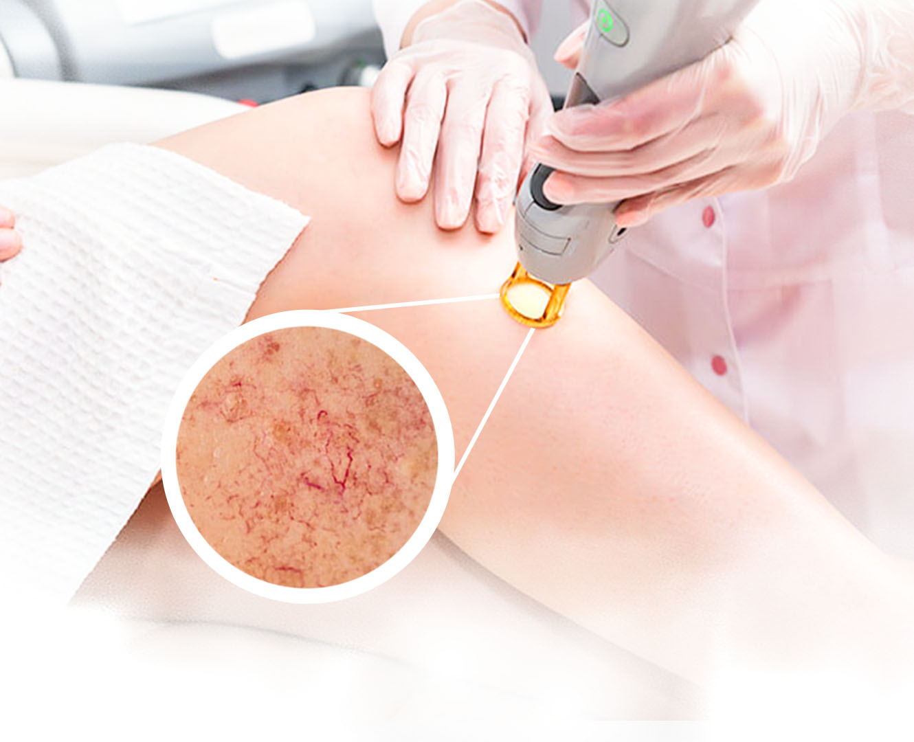 Lazerle Genital Siğil Tedavisi Hakkında Sık Sorulan Sorular