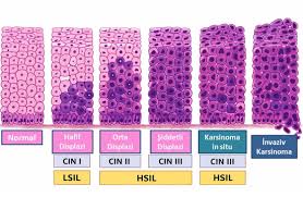 CIN2 CIN3 Konizasyon Ne Zaman Gerekir