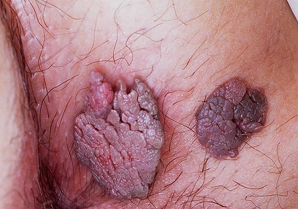 Genital Siğil Belirtileri ve Tanı Yöntemleri:HPV Hakkında Bilmeniz Gerekenler