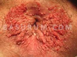 Anal Siğil (Kondilom) Nedir, Nasıl Geçer? Belirtiler ve Tedavi Yöntemleri. Uzman Rehberi